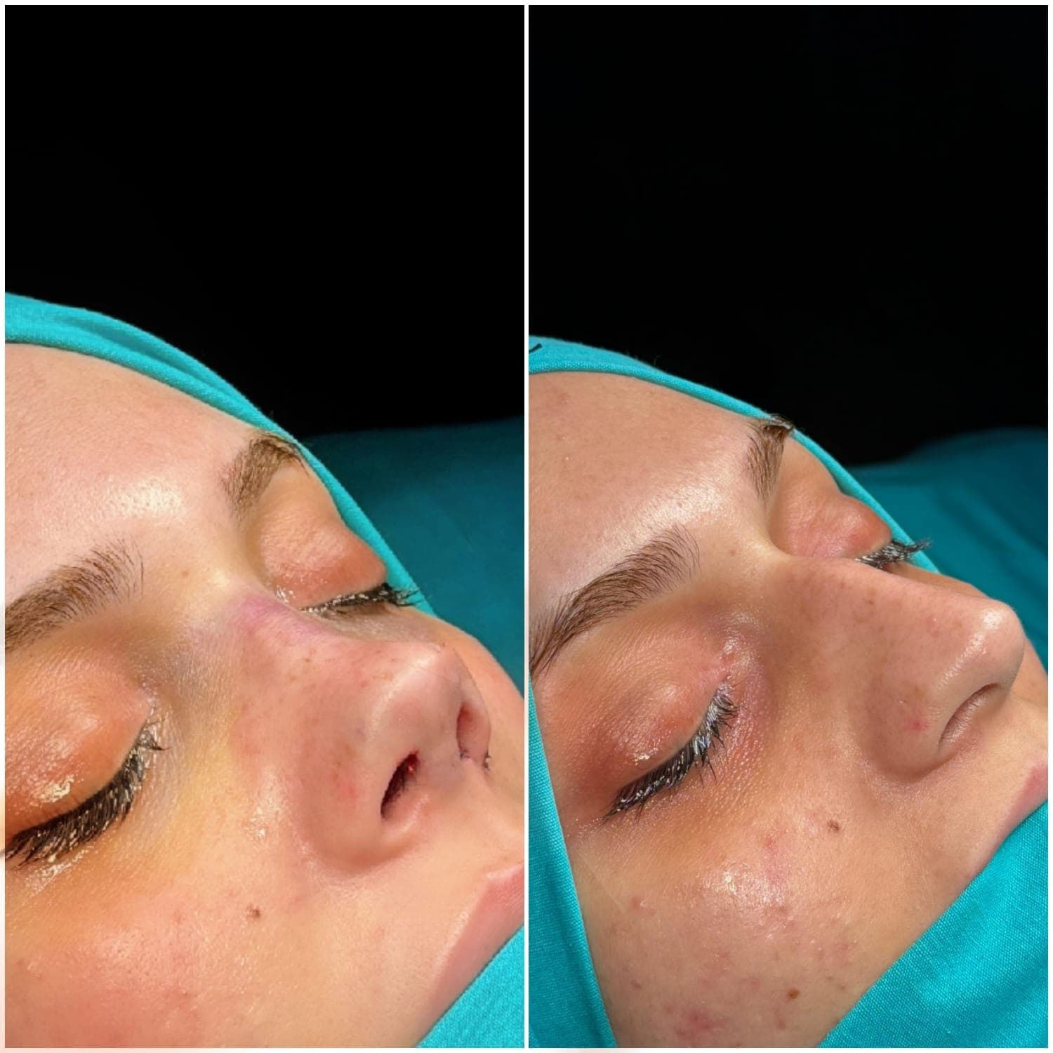 Revisionsrhinoplastik